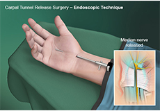 Endoscopic Carpal Tunnel Surgery