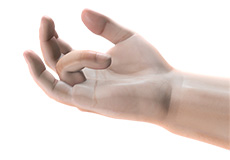 Dupuytren’s Contracture