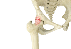 Femoroacetabular Impingement