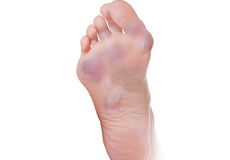 Foot Rheumatoid Arthritis