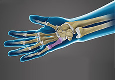 Fractures of the Hand and Fingers