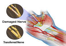 Nerve Transfers