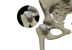 Hip Cartilage Restoration