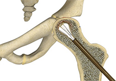 Hip Reconstruction