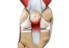 Patellar Tendinitis