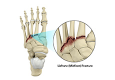 Lisfranc Fracture