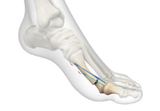 Minimally Invasive Bunion Surgery