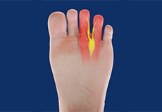 Morton’s Neuroma