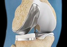 Unicompartmental/Partial Knee Replacement