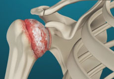 Arthritis of the Shoulder