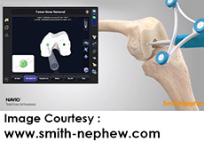 Smith & Nephew Navio Robotic TKR