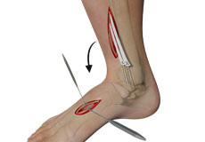 Tendon Transfer