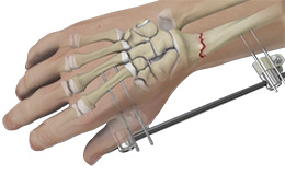 Wrist Fracture Fixation