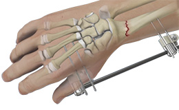 Wrist Fracture Fixation